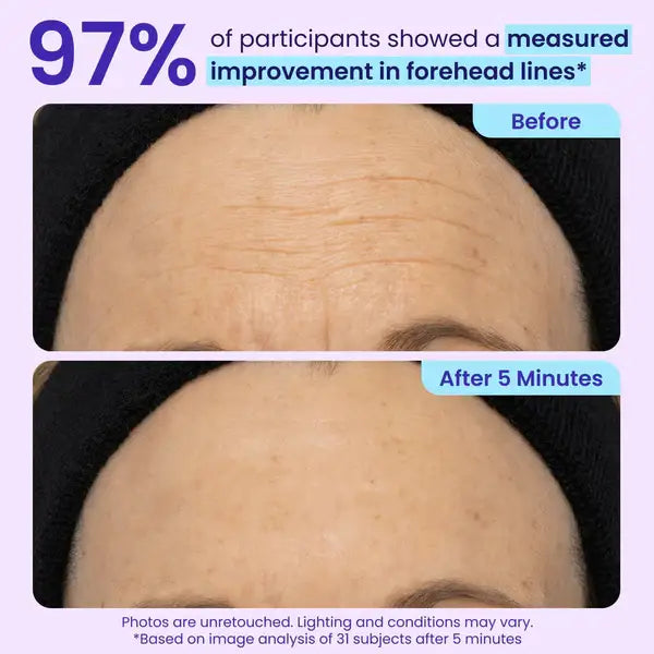 97% measured improvement in forehead lines*
