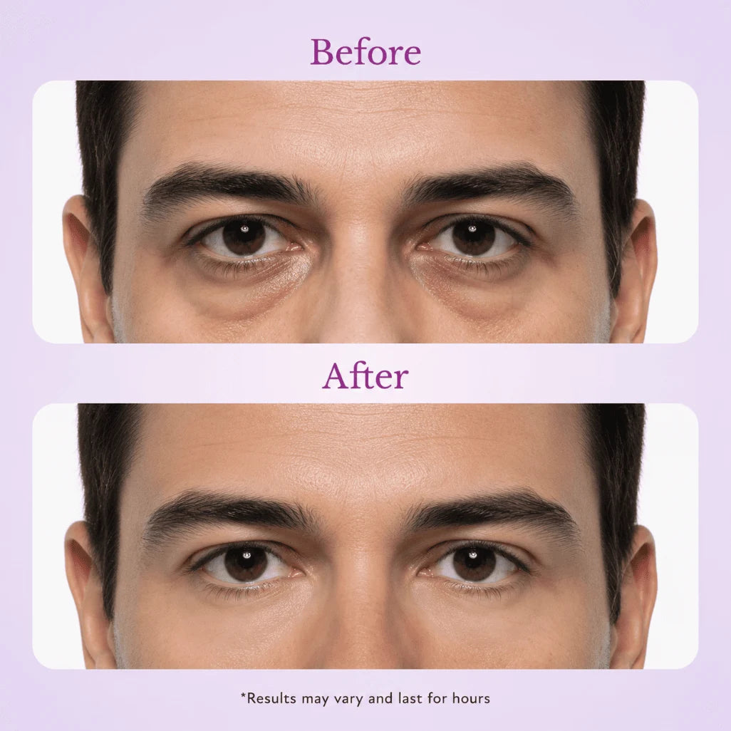 TopSpire eye treatment before after