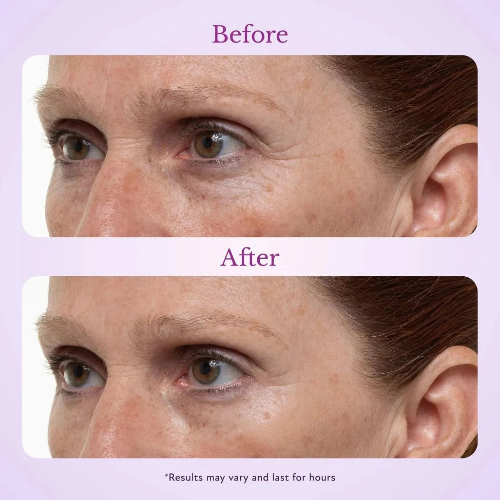 TopSpire under eye results
