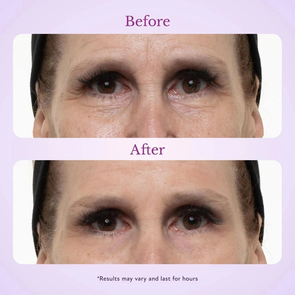 TopSpire eye lifting effect