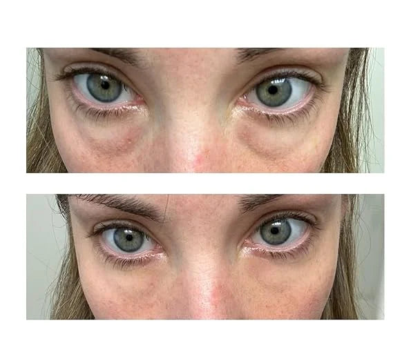Fempick eye gel customer result image