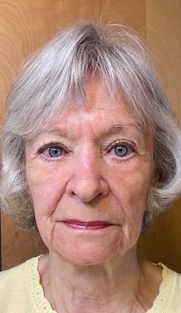 Fempick eye gel application image