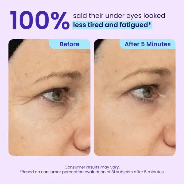 TopSpire Eye Bag Instant Eraser, Tightens, Firms, & Blurs Wrinkles